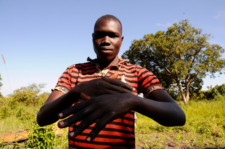 Michael Inyani, 30, says he was beaten with sticks and slammed in the chest with guns after being mistaken for a rebel in South Sudan. (Carolyn Thompson)