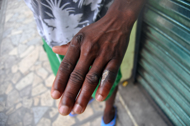 Senussi, a migrant from Guinea, shows the wound he received while crossing Central America. (Irene Savio)